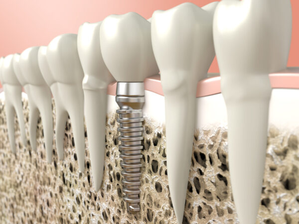 Advantages Of Full Mouth Dental Implants