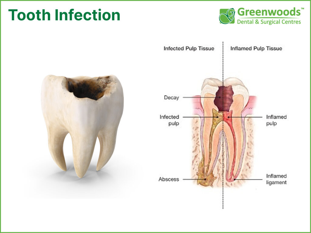 Tooth infection 
