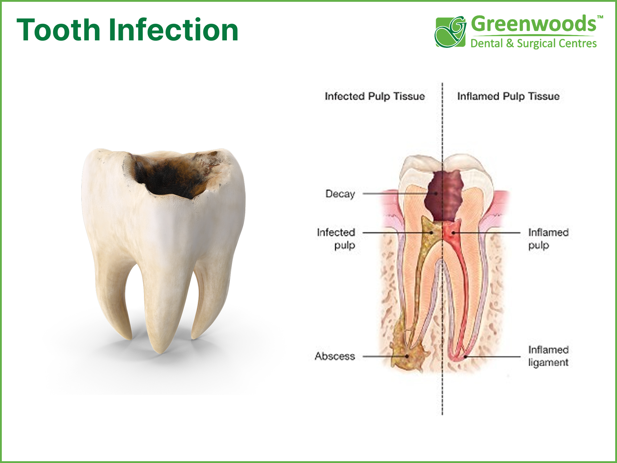 Causes of Tooth Pain & How to Relieve It | Greenwoods Dental