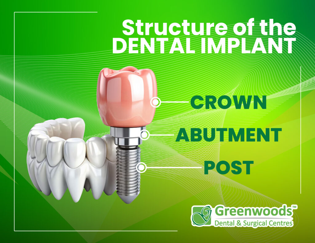 dental implant