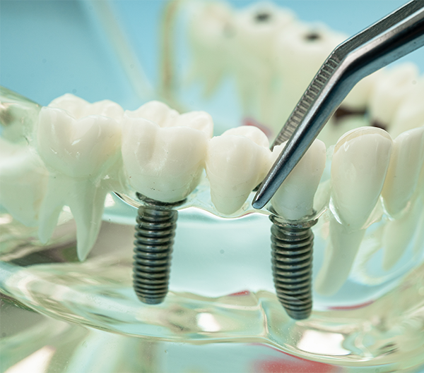 Dental implant treatment in Winnipeg