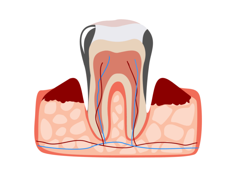 Periodontal Disease: Your Guide to Healthy Gums and a Brighter Smile