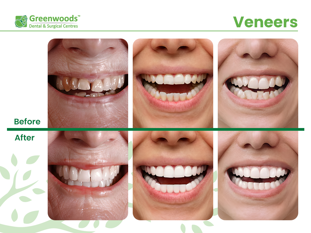 Veneers Before and After