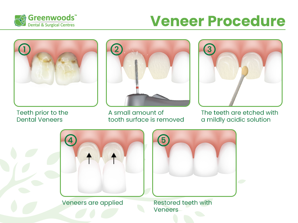 Veneer Procedure