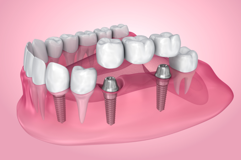 Dental Implants vs Dentures in Winnipeg: Cost, Benefits & Which Is Better (2026 Guide)