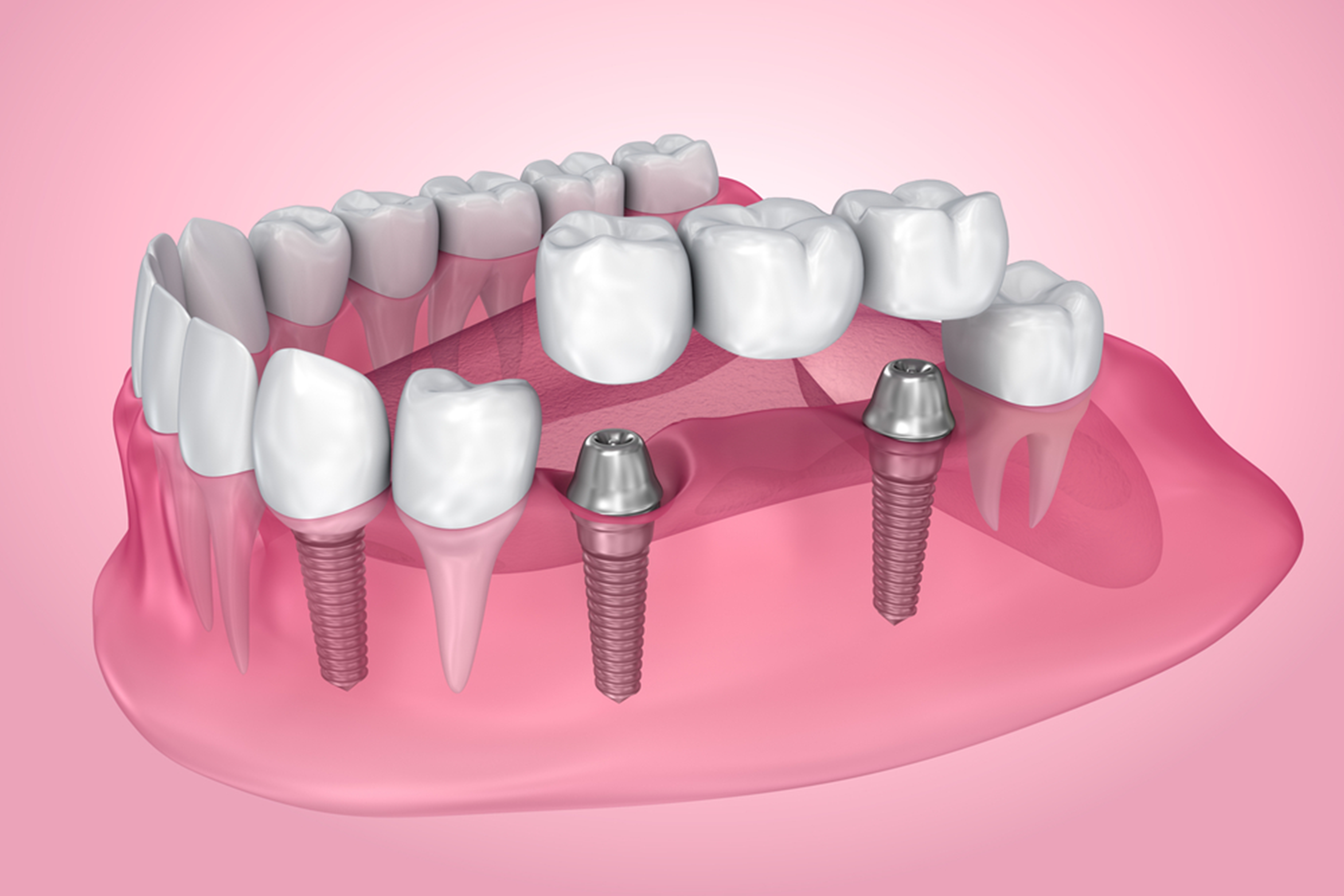 why choose dental implants