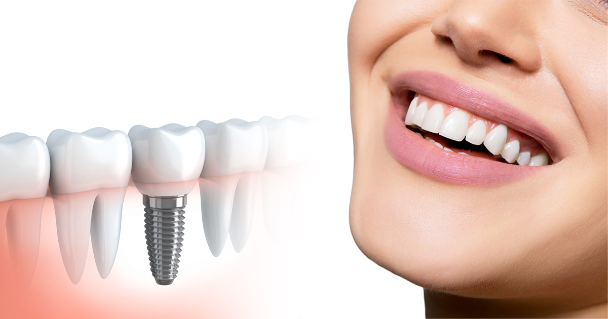 why are dental implants necessary