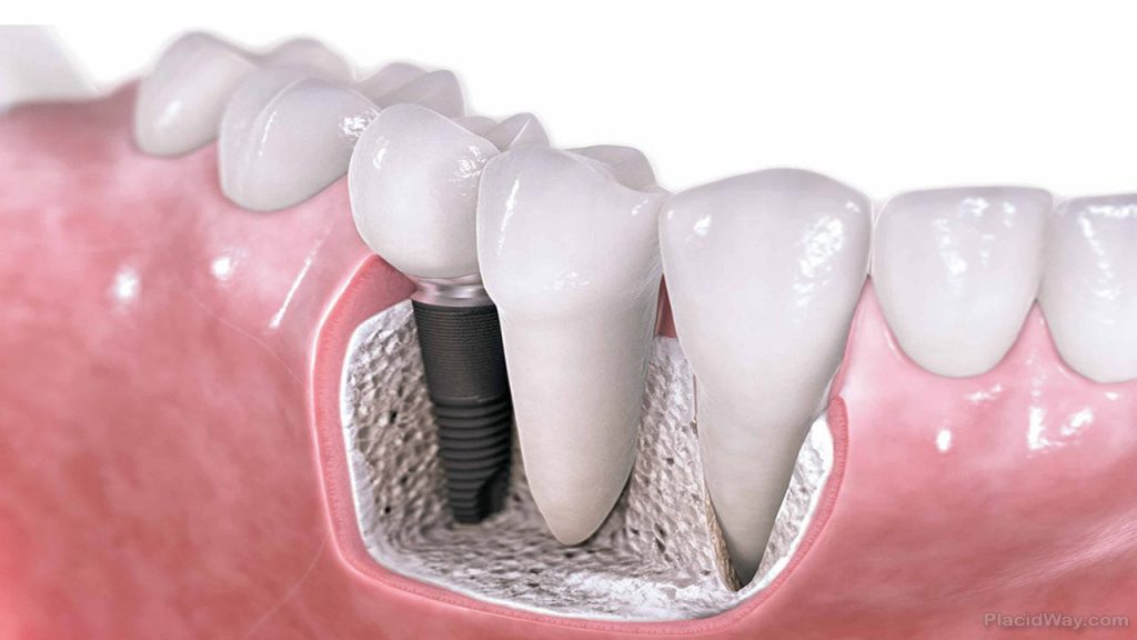 5 benefits of dental implants in winnipeg