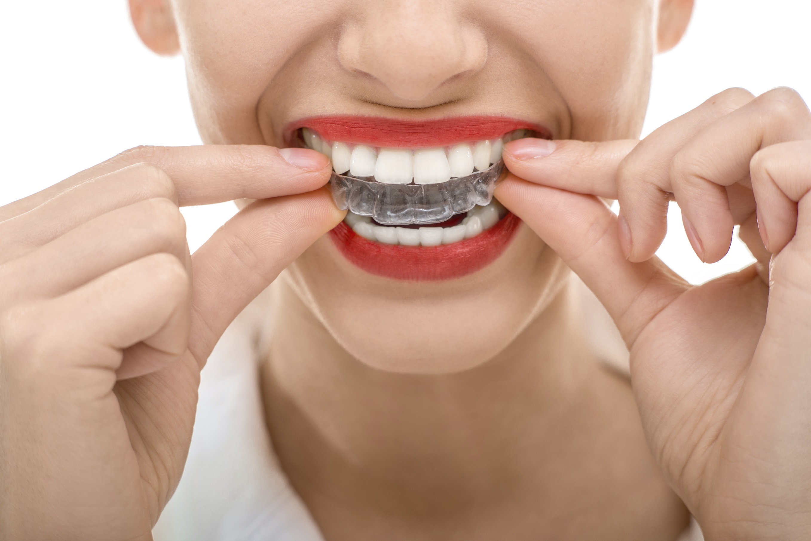 5 cool things you did not know about invisalign