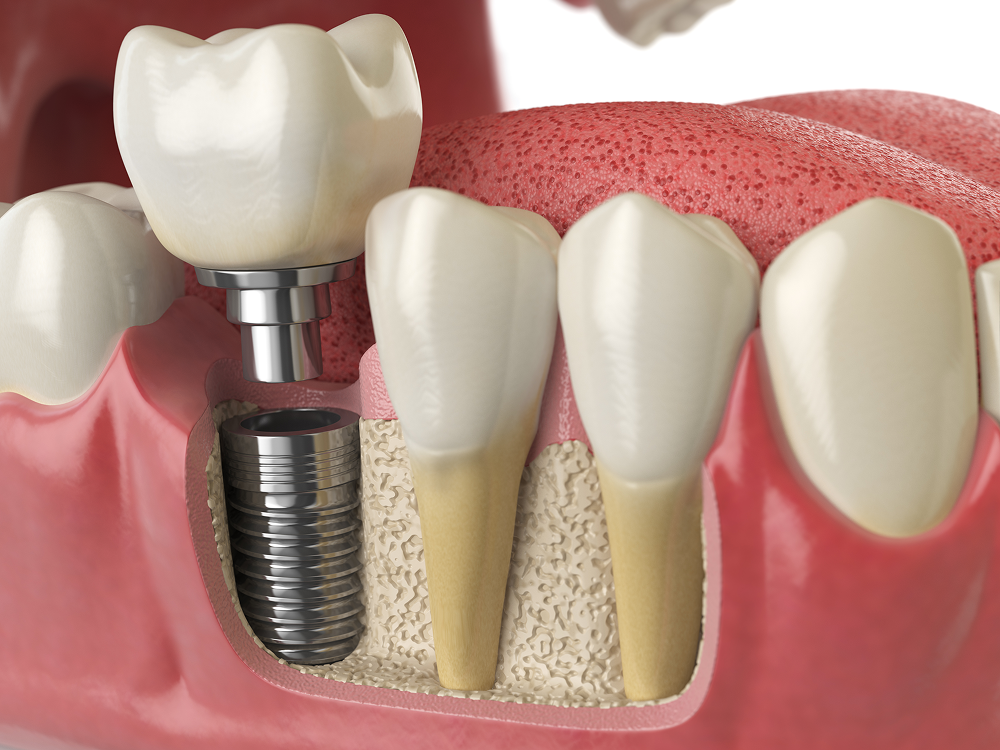 Anatomy of Dental Implant