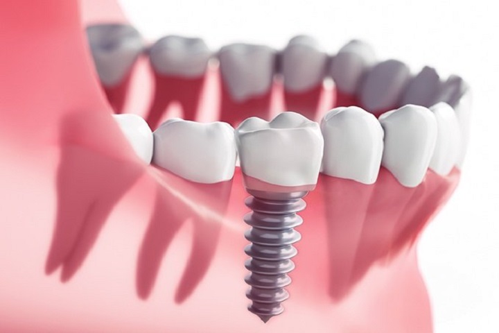 the truth about dental implants