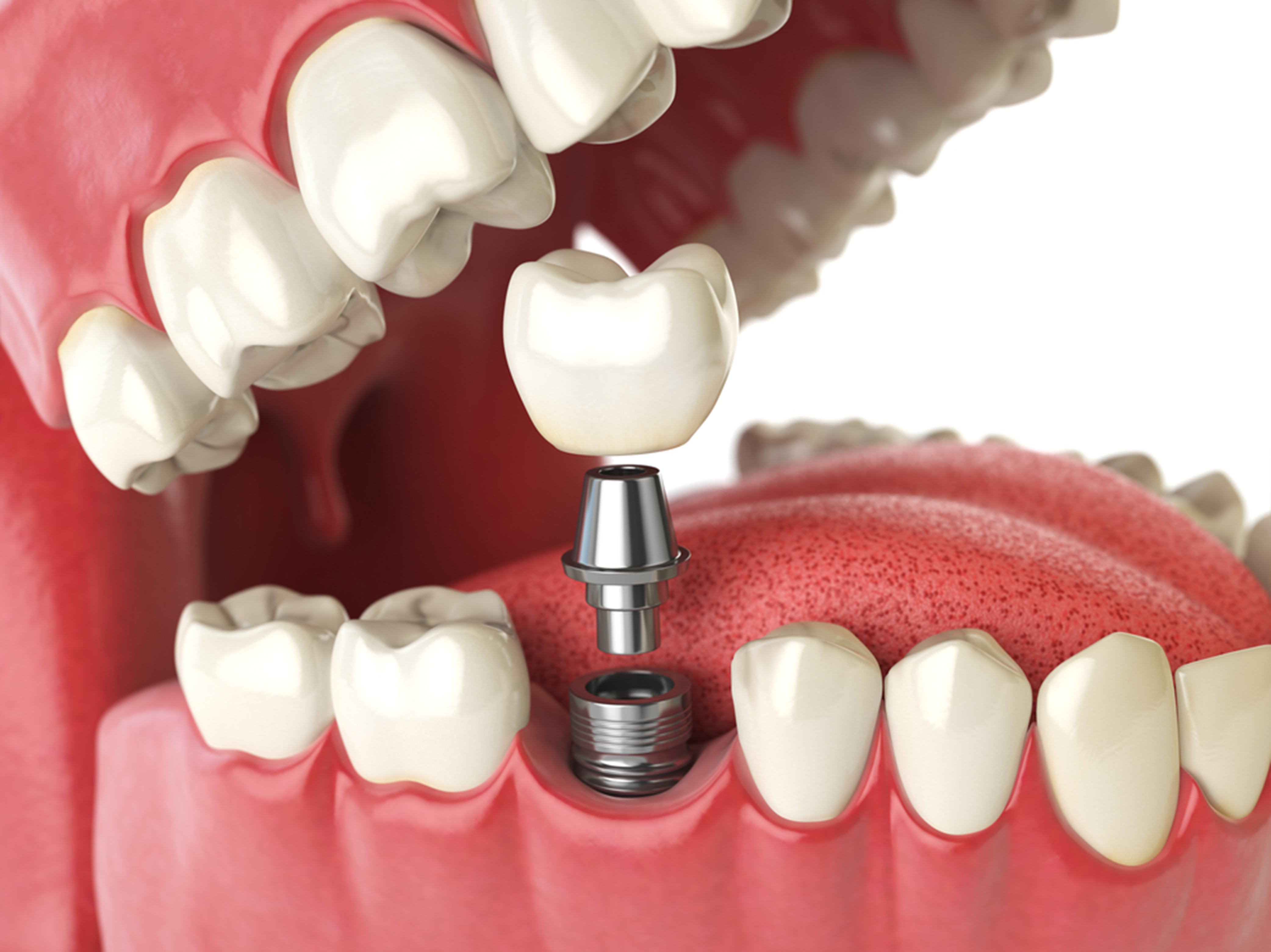 important facts about dental implants