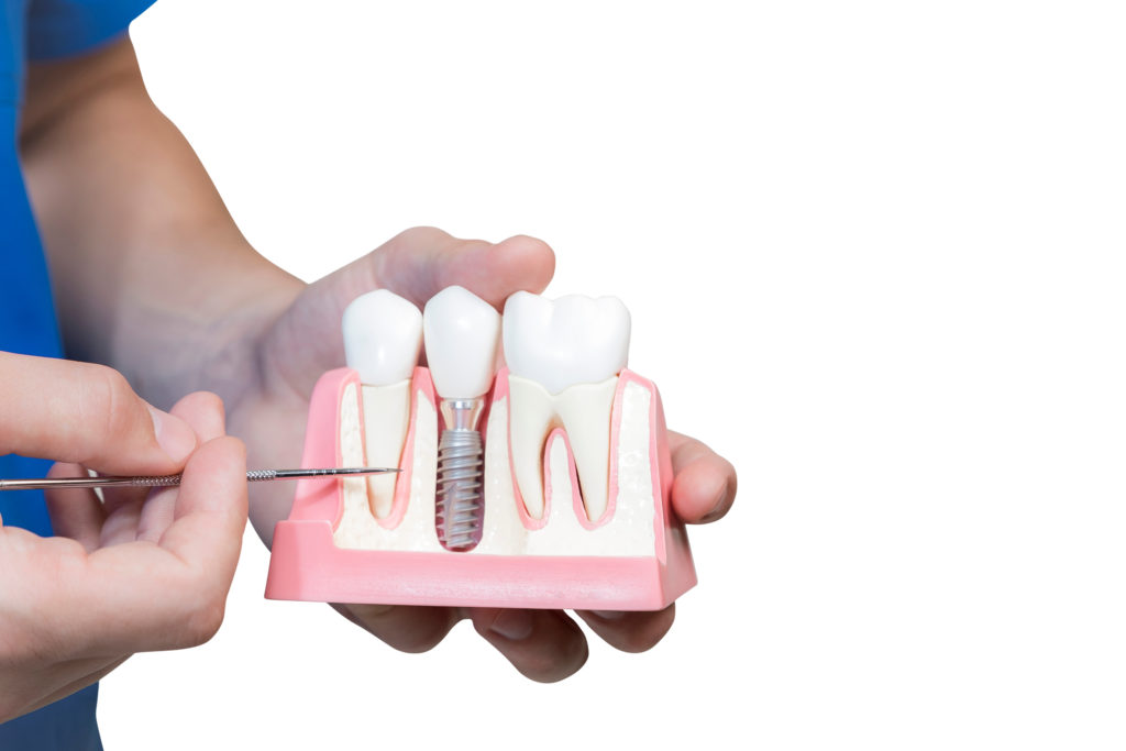 implant dentistry its complications and how you can fix them