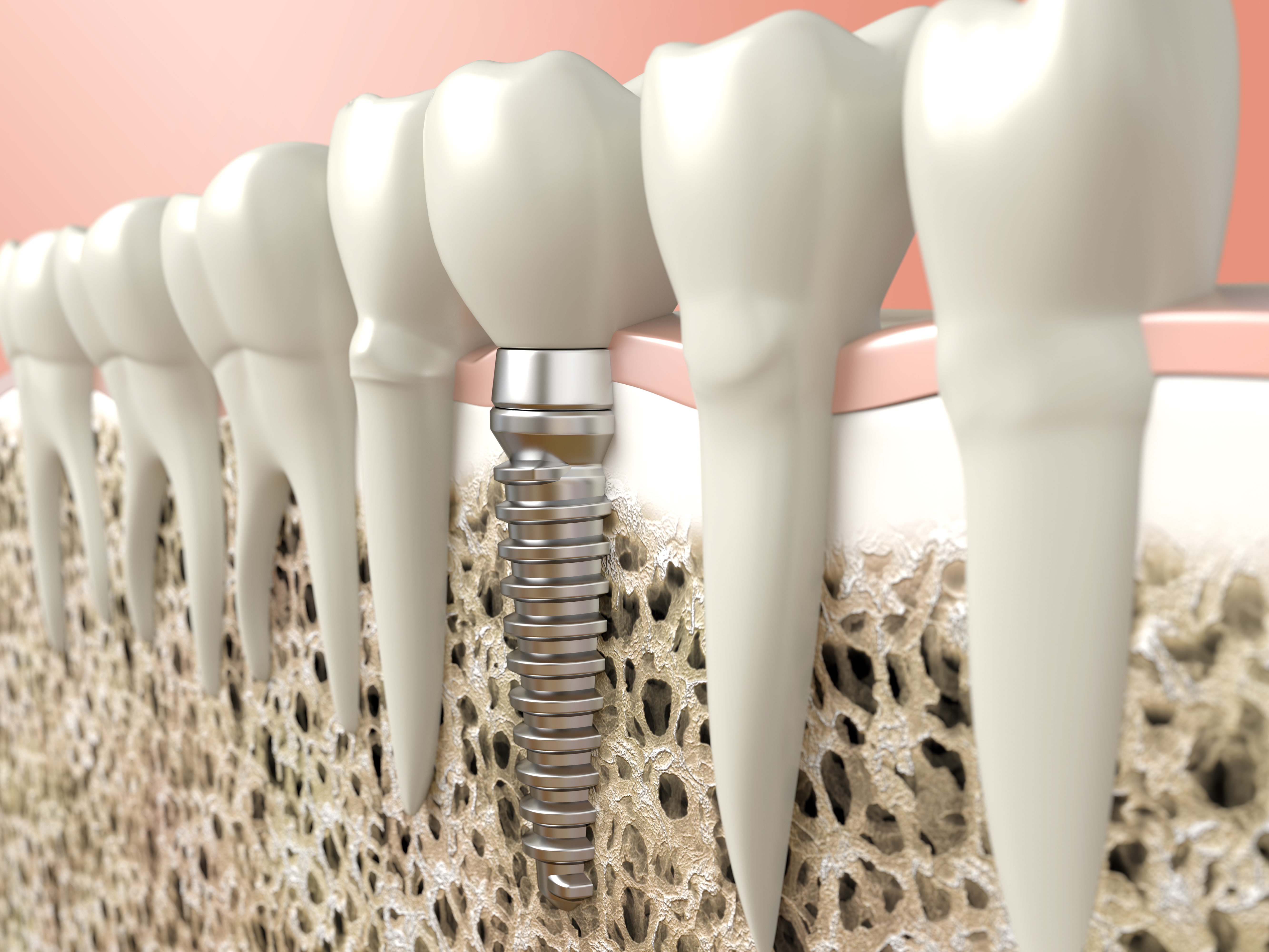 advantages of full mouth dental implants