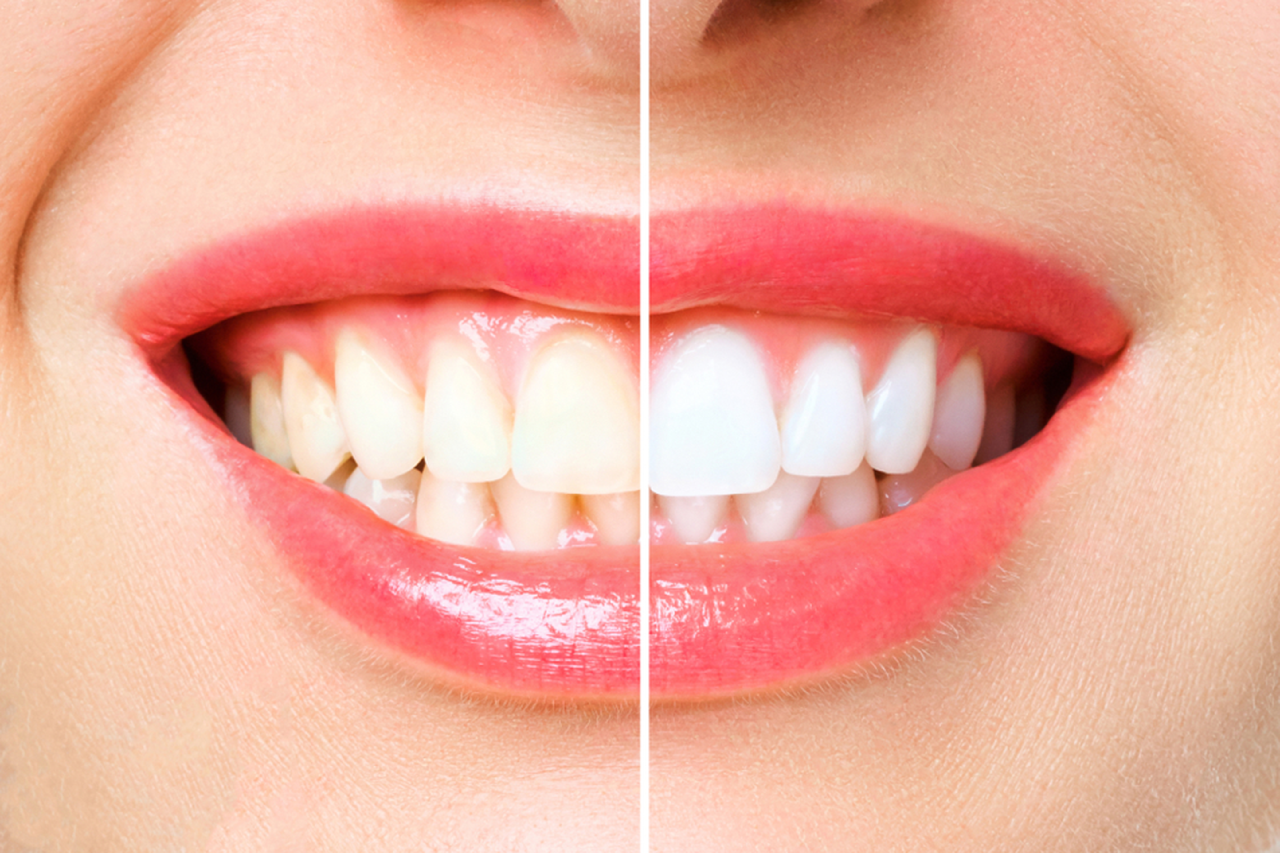 teeth whitening all there is to know