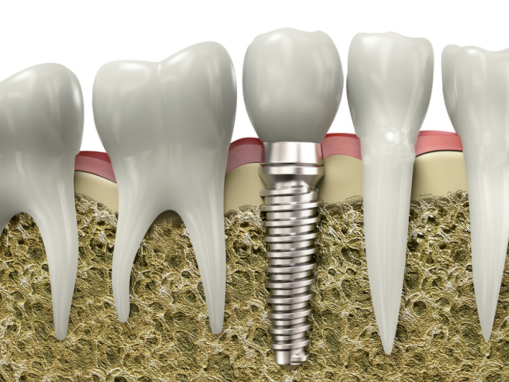 are you a good candidate for dental implants