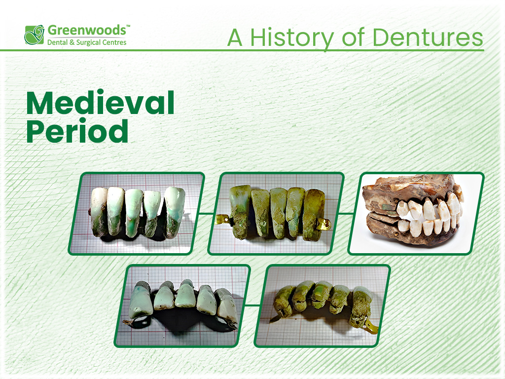 Dentures during Medieval Period