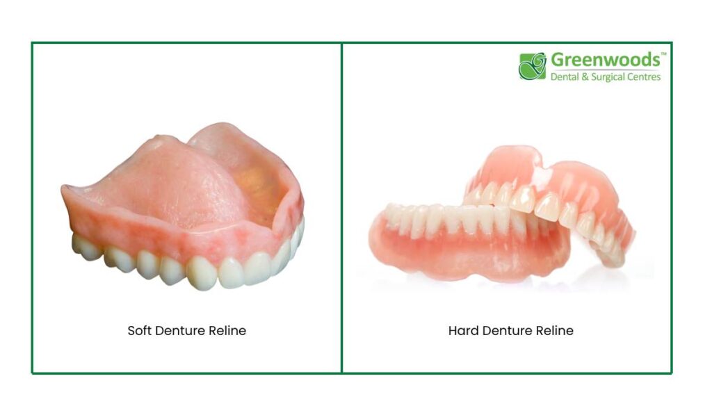 Types of denture relines