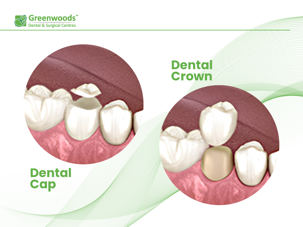 Dental Cap or Dental Crown: differences 