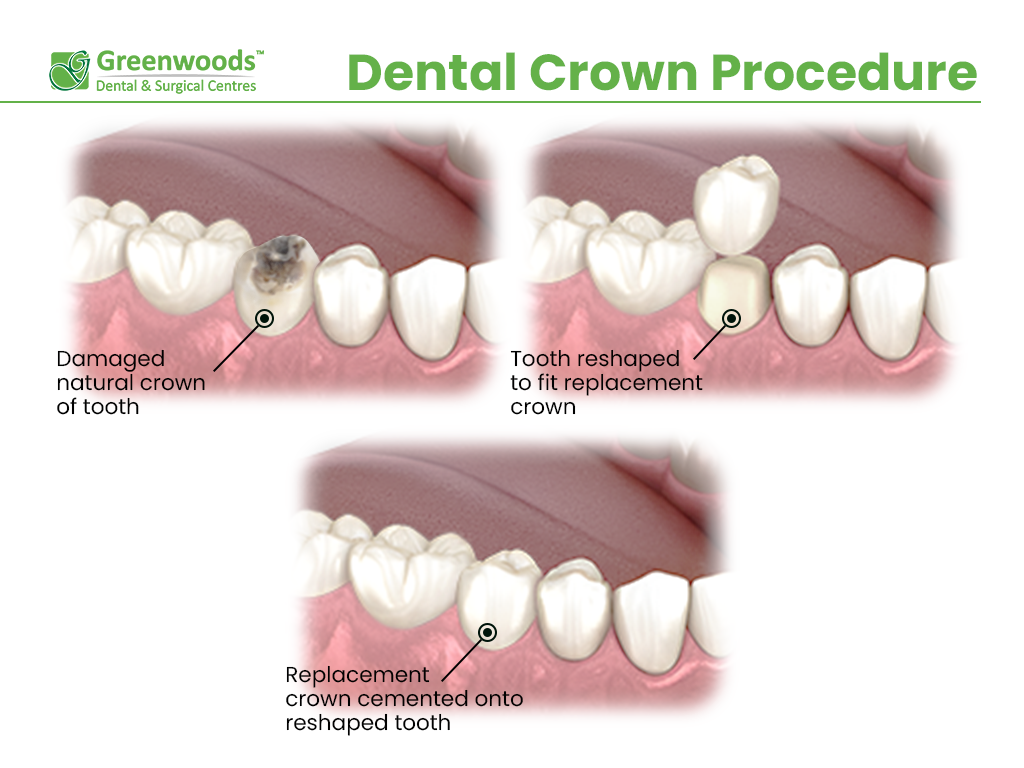 Steps of dental crown procedure