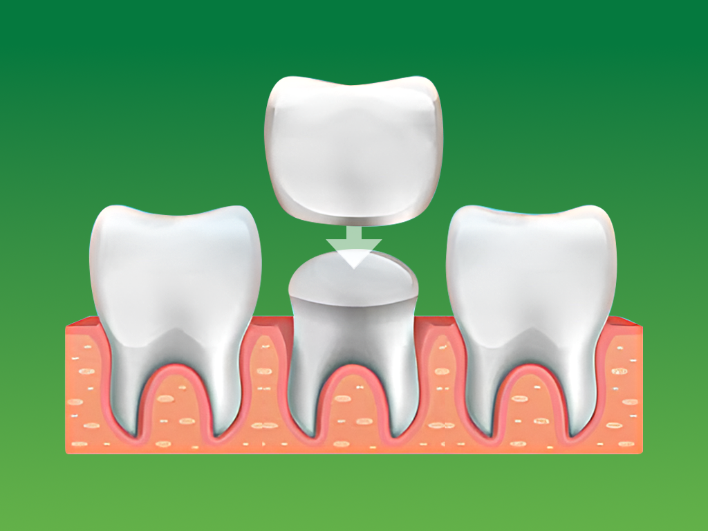 Understanding Dental Crowns: The Complete Essentials for Your Smile