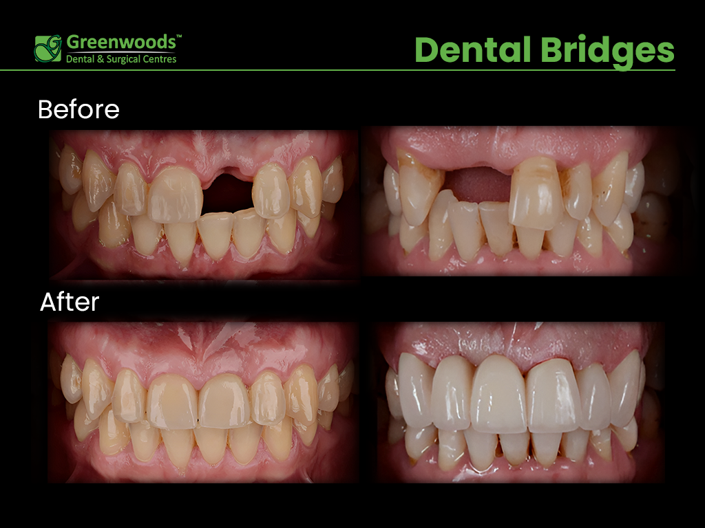 Before and after dental bridge