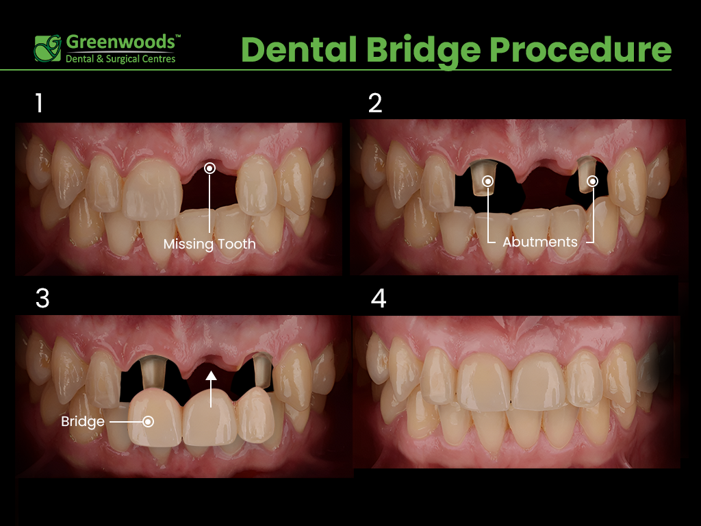 Steps of dental bridge procedure