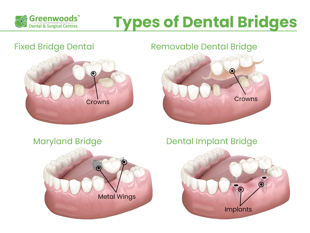 Types of Dental Bridge: Fixed dental bridge, removable dental bridge, maryland dental bridge, dental implant bridge