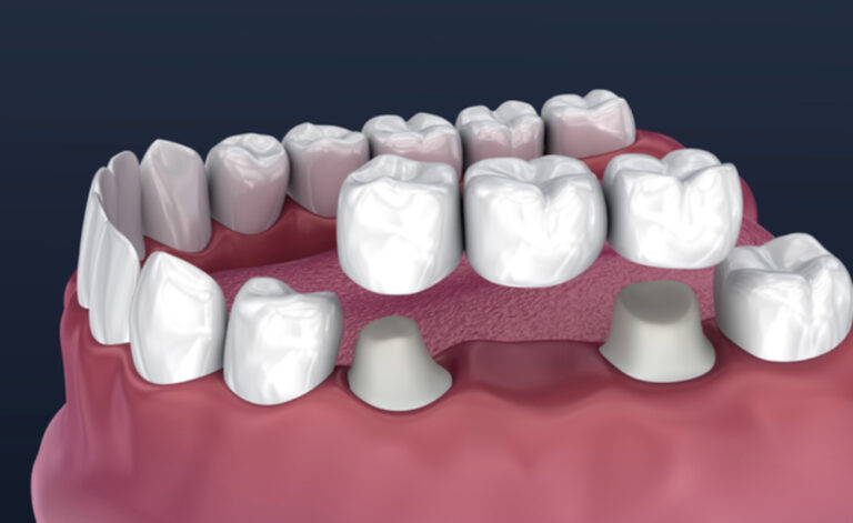 The Ultimate Guide to Dental Bridges