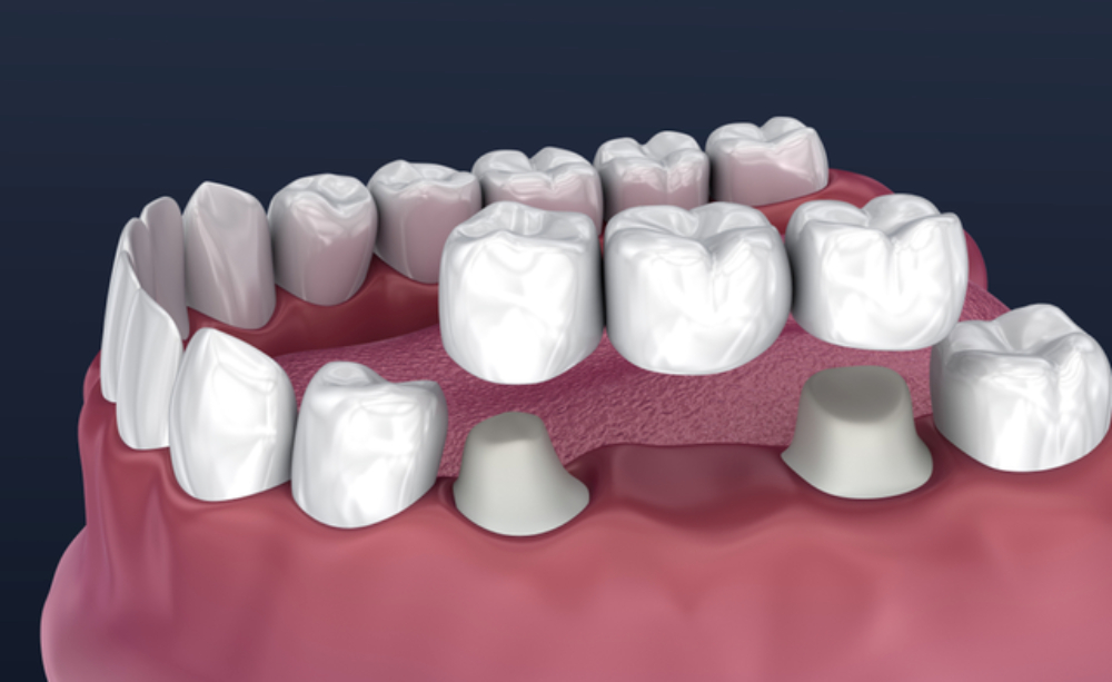 what exactly is a dental bridge and how does it work