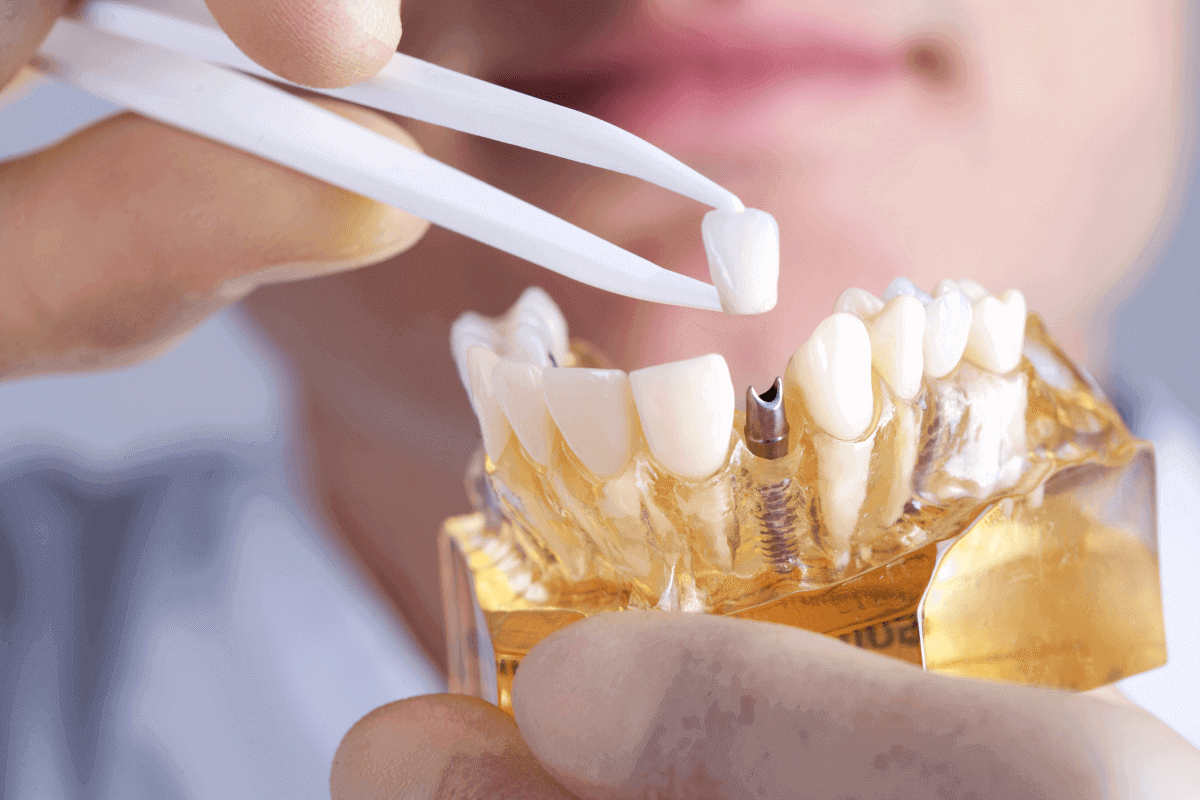 what are the benefits of having dental implants