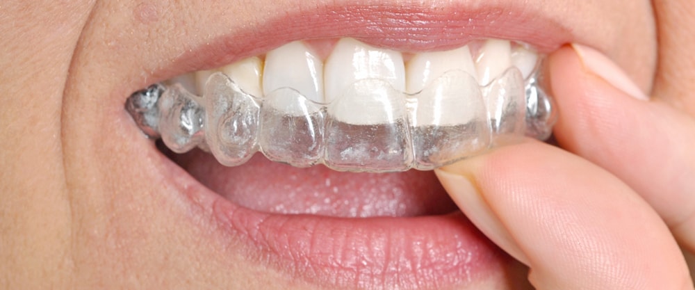 Lake Erie Dental Blog  Clear Braces for a Modern Approach to