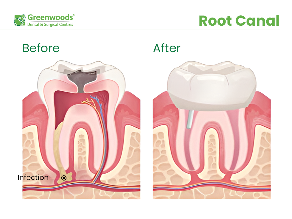 Before and after Root Canal Treatment