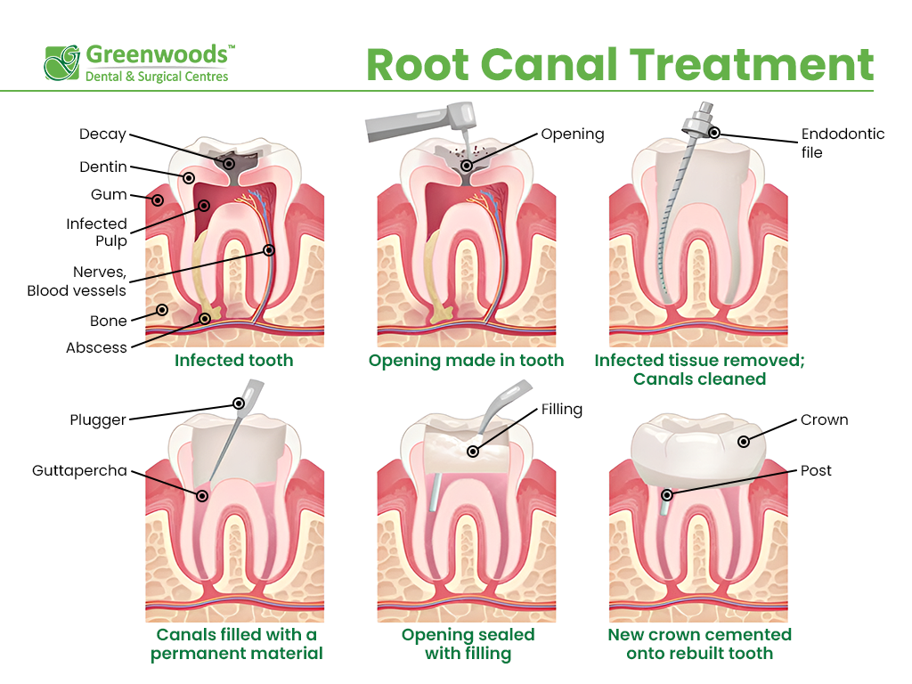 Step by step instruction of root canal treatment