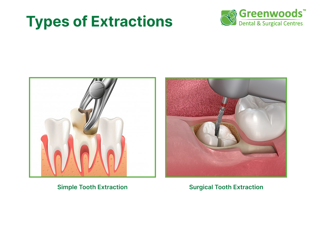 Types of tooth infections