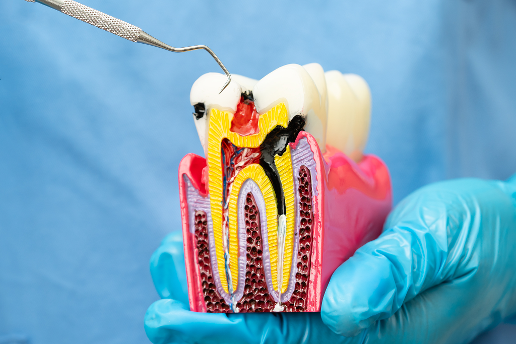 Scheme of root canal treatment