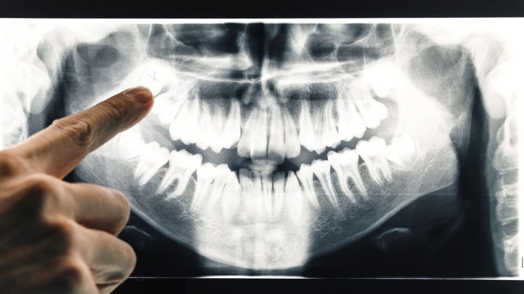 X-ray of teeth indicating infection