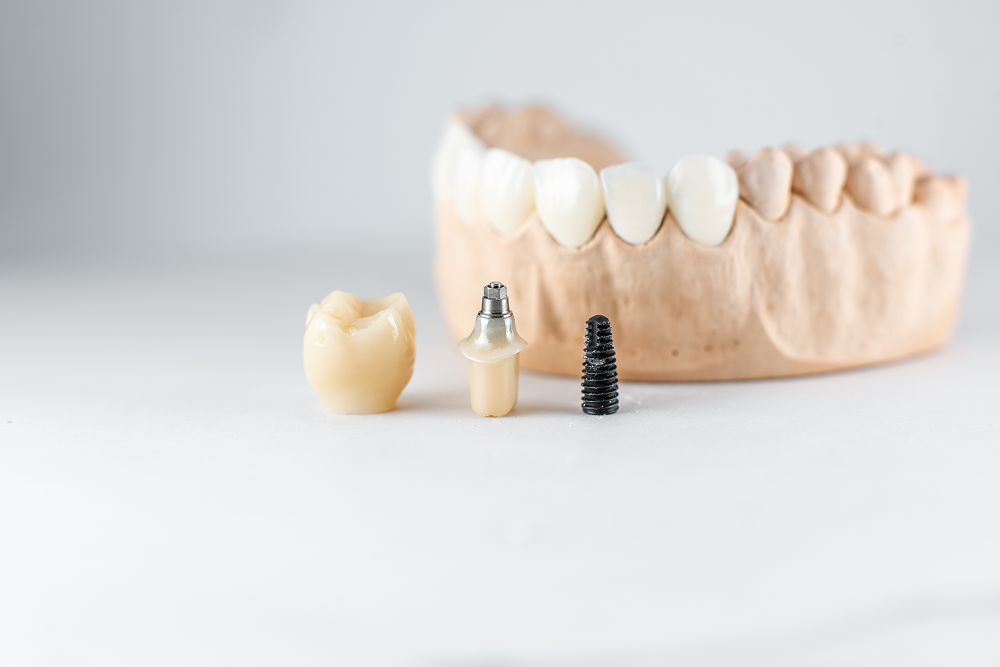 Model of Artificial Jaw And Dental Implant