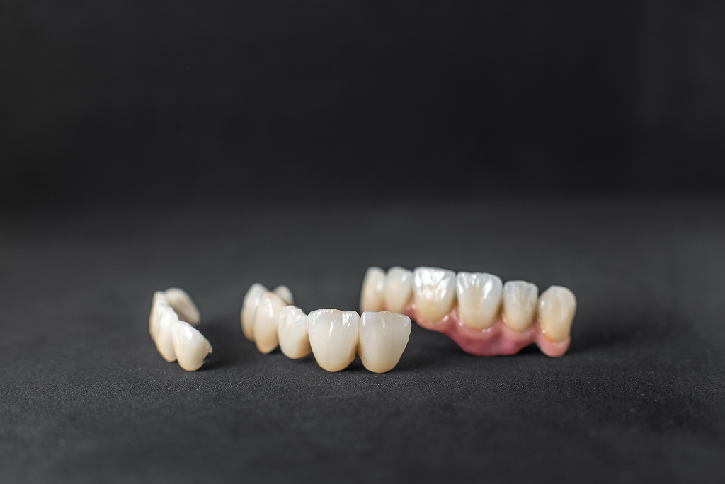 Dental Crowns and Bridges for Missing Teeth