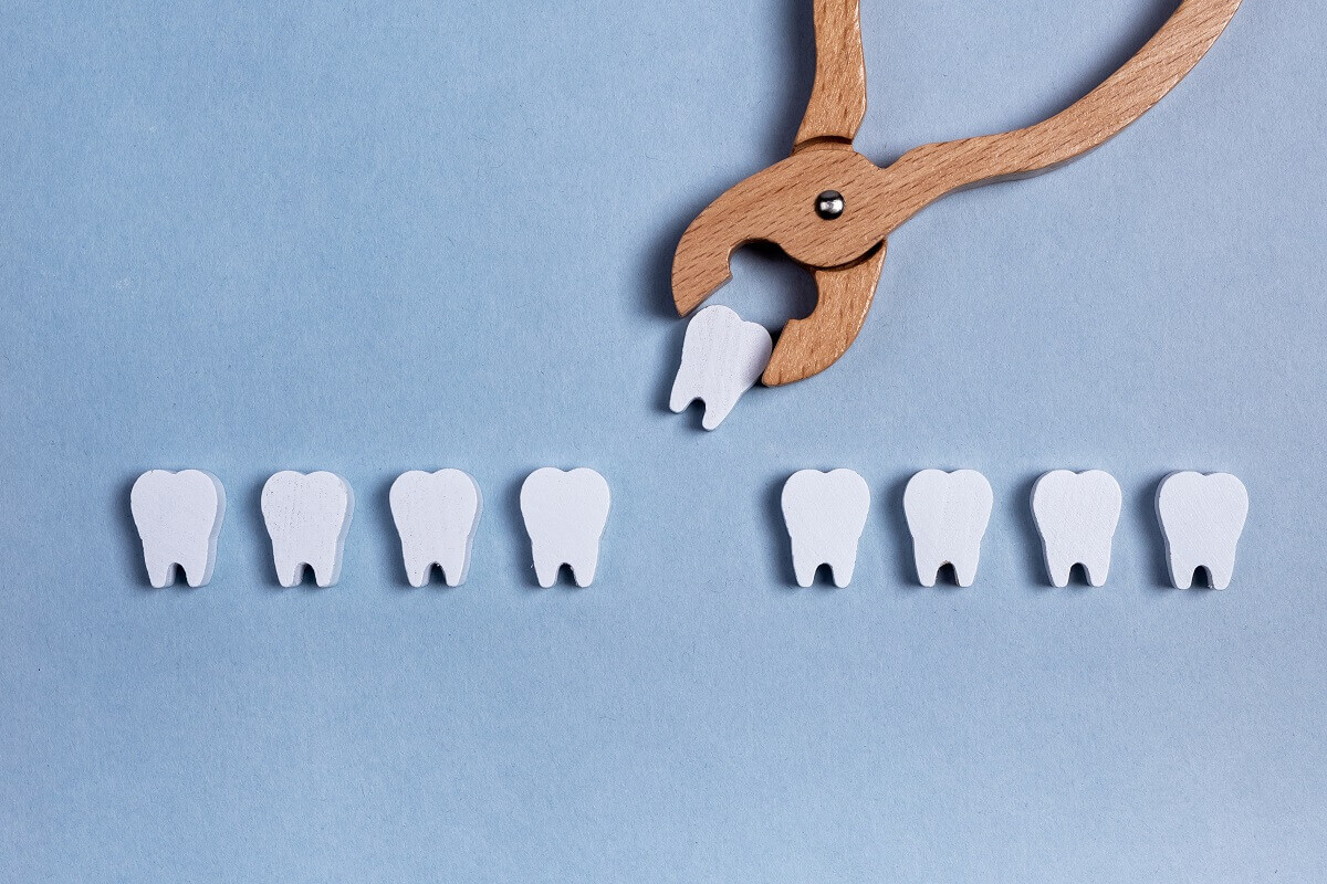 How Long Does It Take for a Tooth Extraction to Heal?