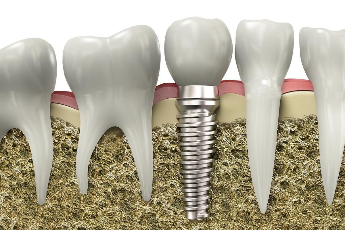 unlocking your perfect smile the power of dental implants