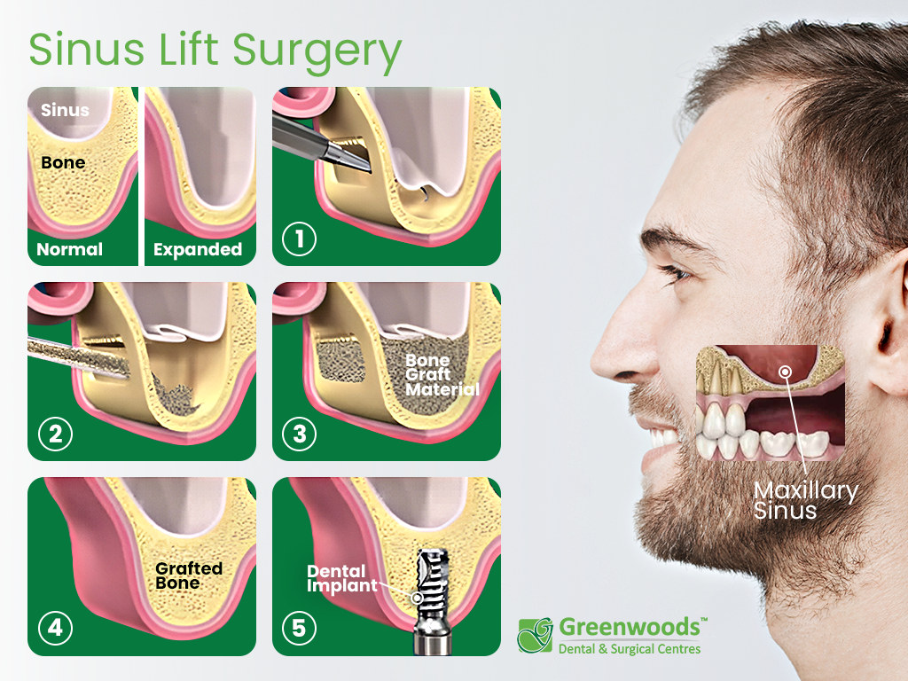 Scheme of Sunis Lift Surgery