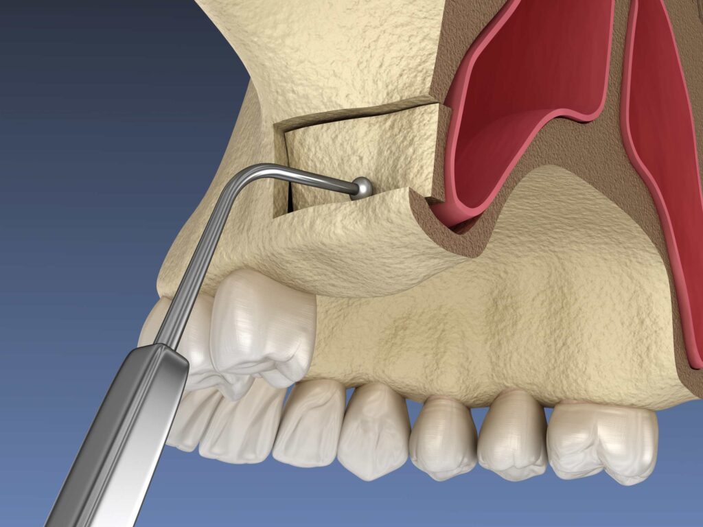 Understanding Sinus Lift Surgery: Enhancing Dental Implants