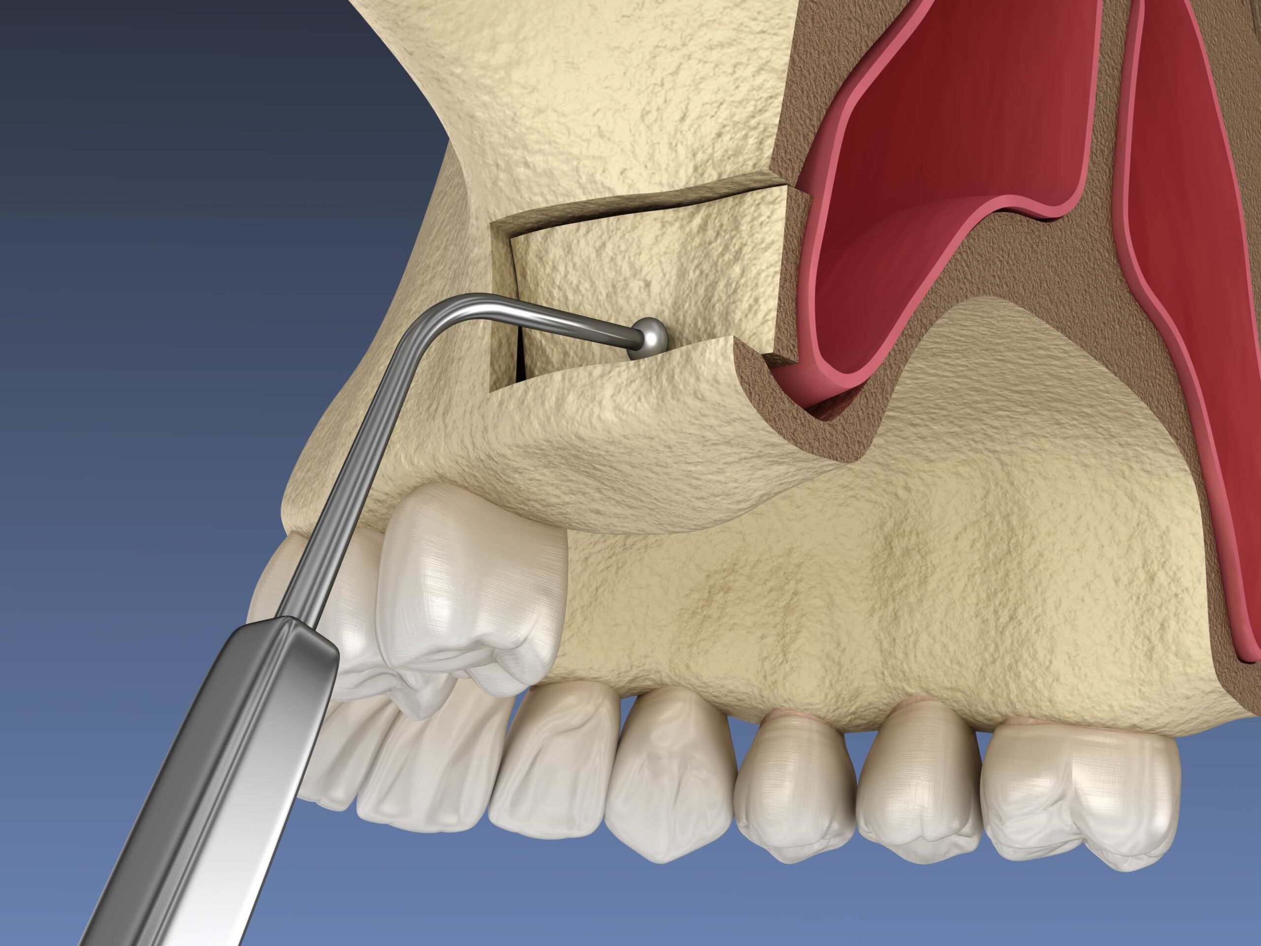 Understanding Sinus Lift Surgery: Enhancing Dental Implants