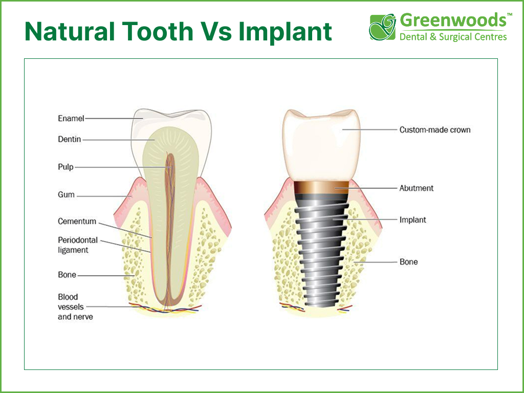 Natural tooth vs Dental Implant 