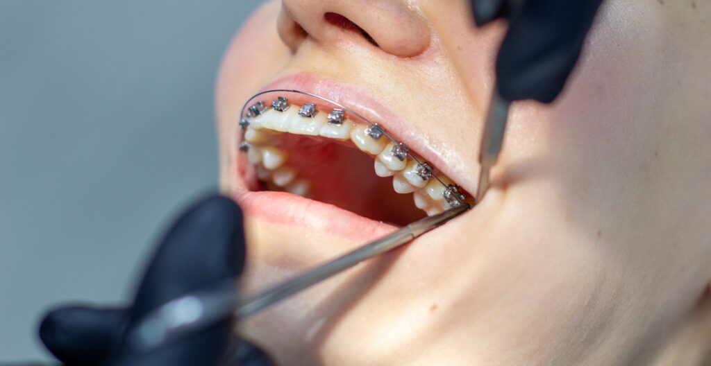 Woman having her loose braces repaired at greenwoods dental 