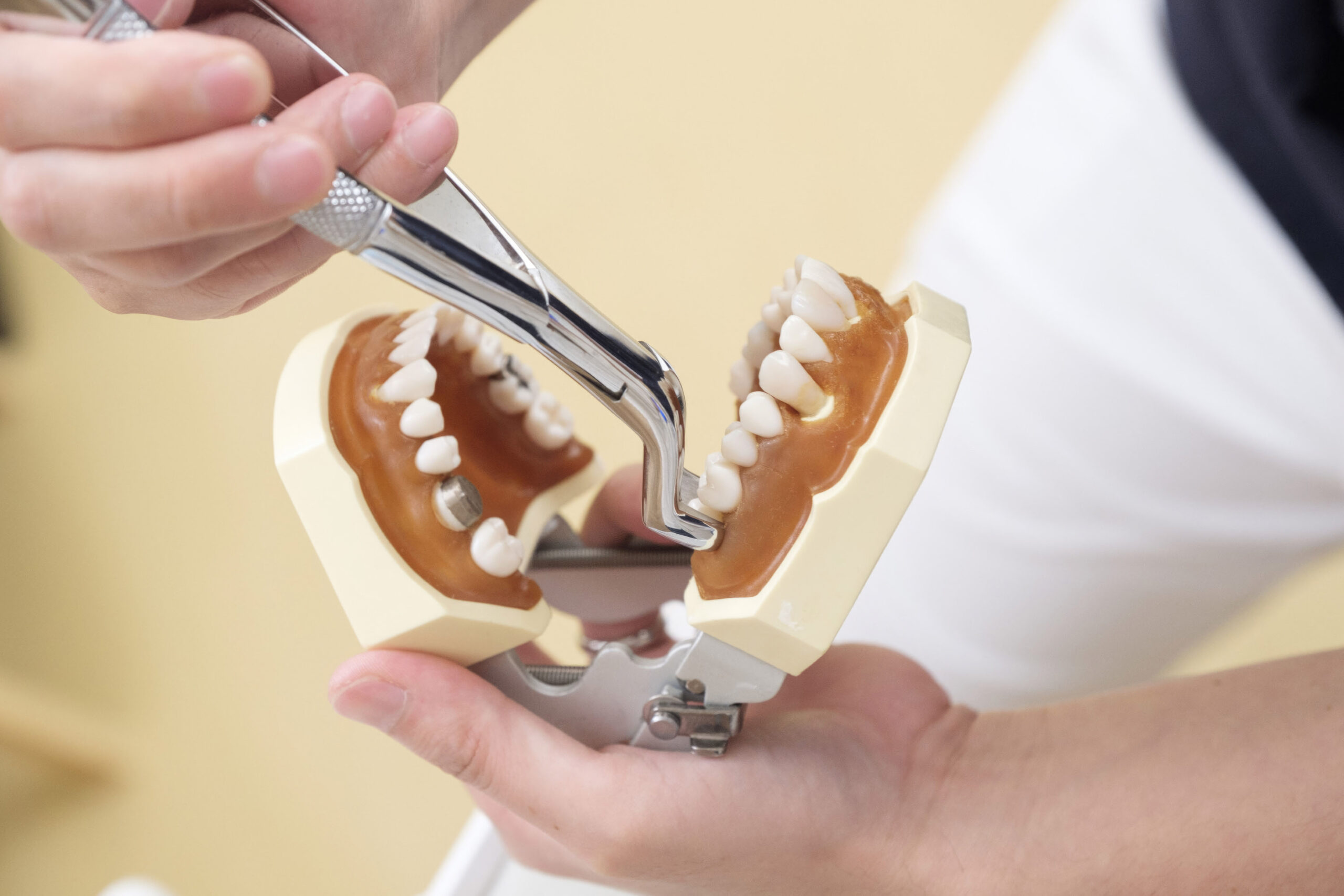tooth extraction at Greenwoods dental