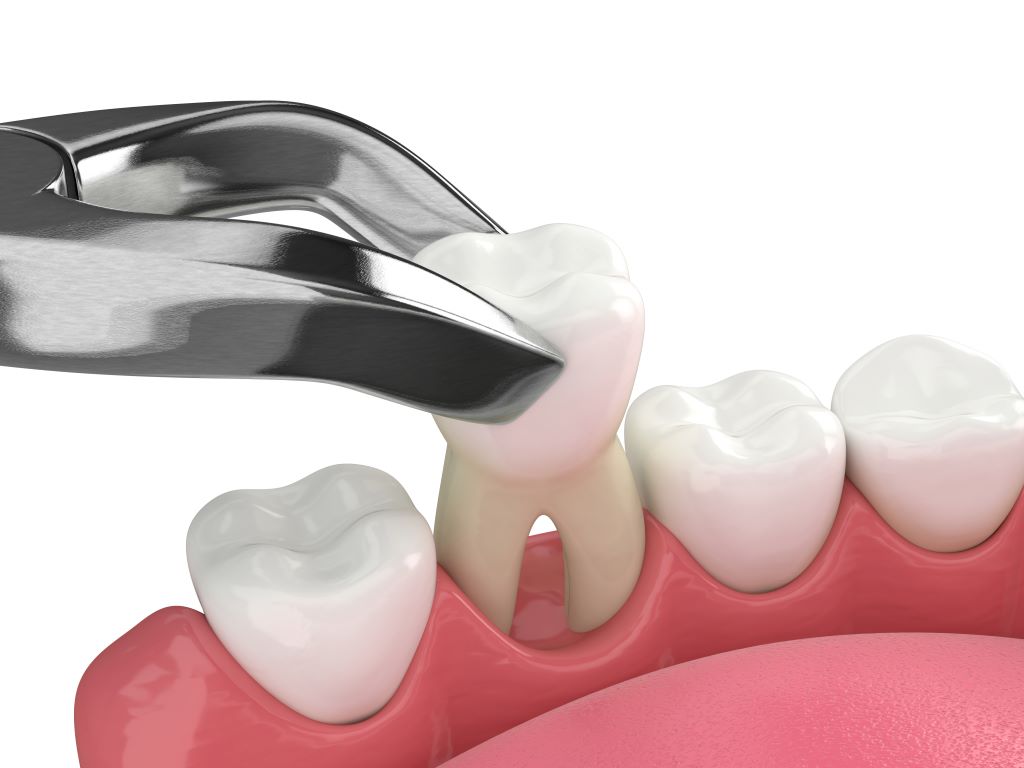 wisdom teeth extractions in winnipeg