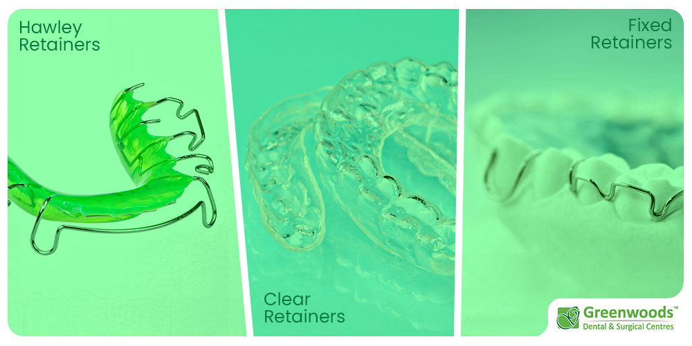 type of retainers