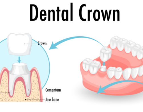 dental crown, tooth crown